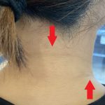 首の痛みや肩こりの方によくみられる首のしわ