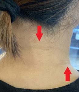 首の痛みや肩こりの方によくみられる首のしわ