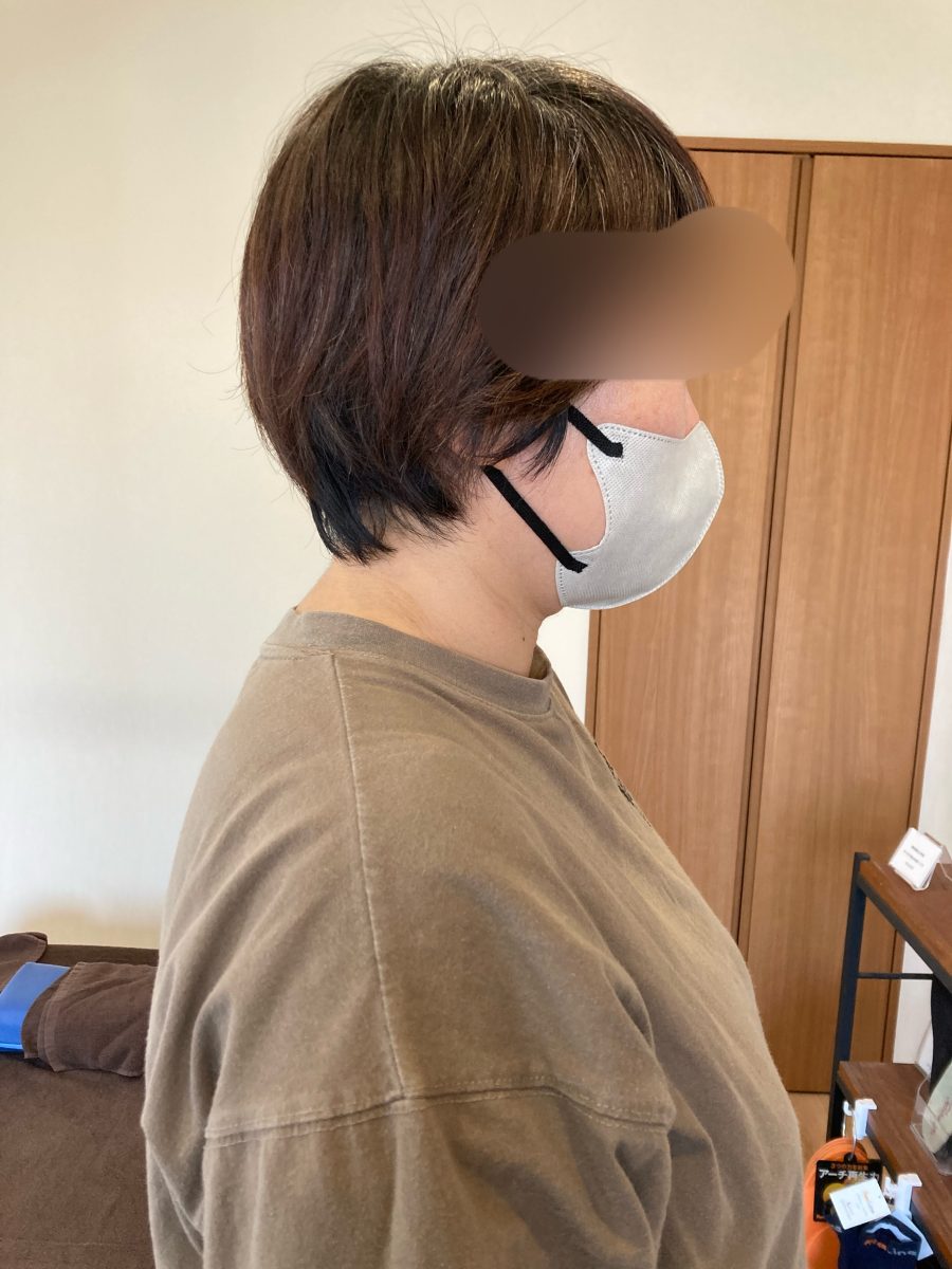 顔が前に出て肩こりや首の痛みで悩まれている方【姶良市整体】