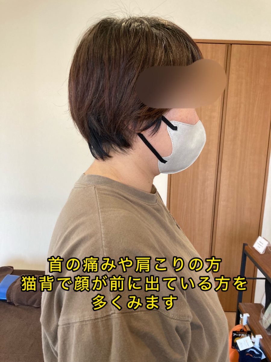 猫背で顔が前に出る原因と整体の必要性【姶良市/整体/肩こり/猫背】